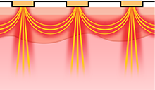 Potenza DIA laser lifting treatment - painless face lift in Seoul