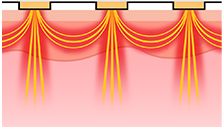 Best English friendly dermatologist in Seoul - Potenza DIA painless laser lifting treatment