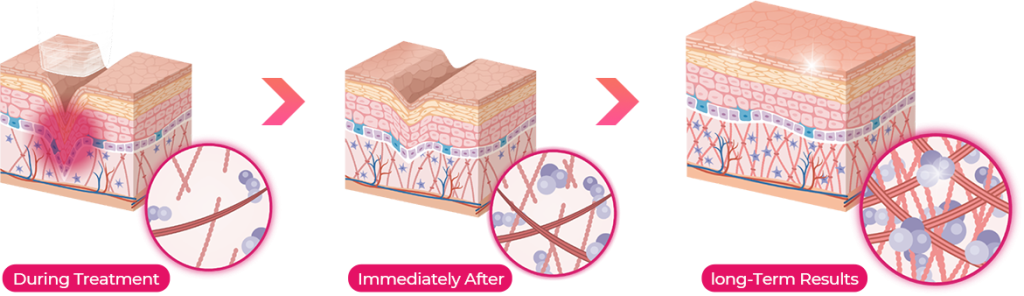 Affordable laser lifting treatment in Seoul