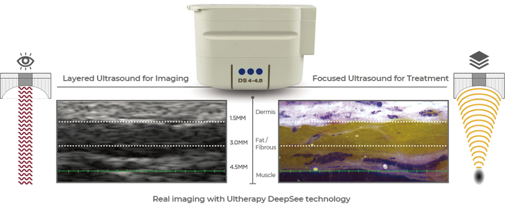 Ultherapy laser lifting treatment in Seoul