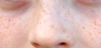 Pigmentation laser treatments in Seoul - skincare for removing freckles