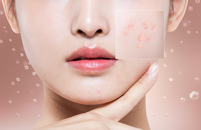 Best skincare treatments for acne prone skin in Seoul South Korea
