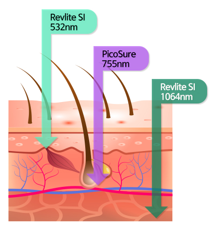 Recommendation for pigmentation treatment in Seoul - English speaking dermatology clinic