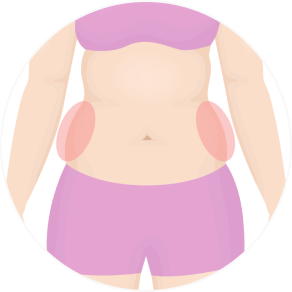 Ulfit, best body lifting laser treatment for weight loss