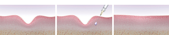 Affordable botox for foreigners in Seoul - the best beauty clinic in South Korea