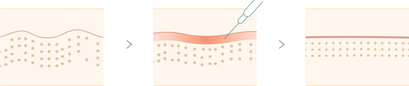 English friendly botox treatment in Seoul