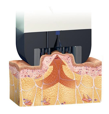 InMode FX fat removing treatment - weight loss without liposuction for English speakers in Seoul