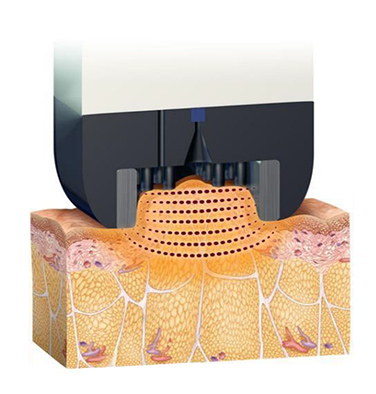 InMode FX, non-invasive fat loss with no liposuction