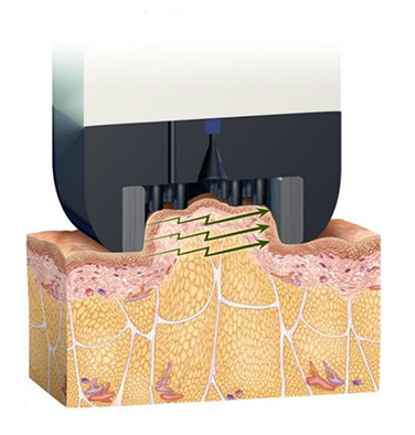 Best weight loss clinic in Seoul - safe and easy fat removal treatment for English speakers