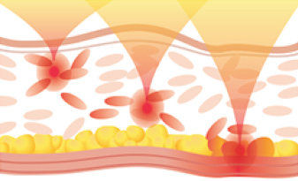 Liftera anti-aging skin lifting treatment - the best English speaking beauty clinic in Seoul