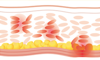 The best anti-aging treatment for foreigners in Seoul - cheap and safe laser lifting for sagging skin