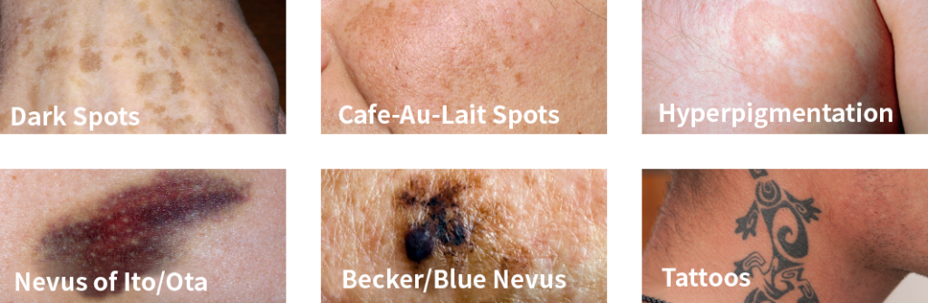 Pico Plus laser toning, tattoo removal, hyperpigmentation, freckle removal treatment in Seoul