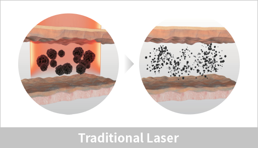 Pico Plus tattoo removal in Seoul, English speaking dermatology clinic