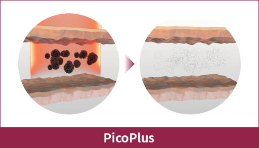 Pico Plus toning laser, skin brightening treatment in Seoul