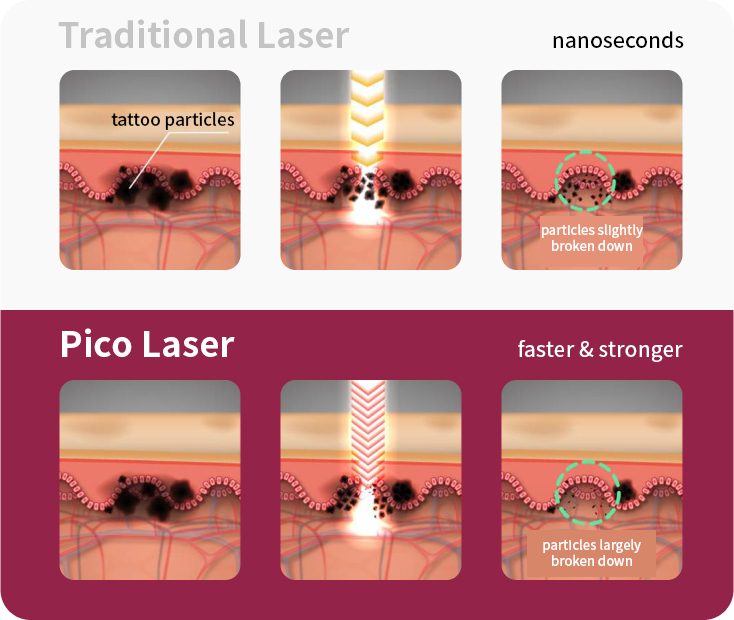 Pico Plus toning laser, tattoo removal, best English beauty clinic in Seoul