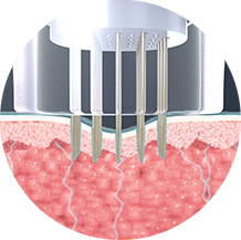 Best Korean beauty clinic for acne scar treatment in Seoul