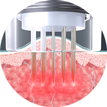 Best English speaking skincare clinic in Seoul for Potenza microneedling treatment