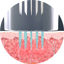 Best foreigner friendly skin clinic in Seoul for Potenza microneedling facial treatment