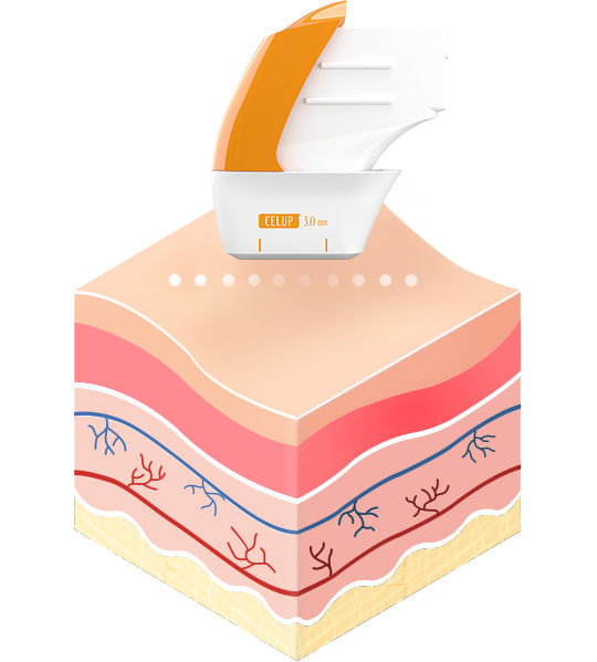 English speaking dermatologist in Seoul - the best laser lifting treatment for foreigners