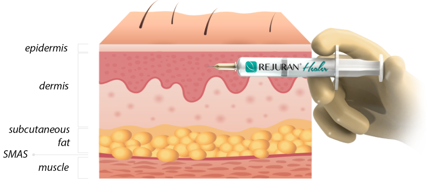 Rejuran Volume, HB+ skin booster treatment, texture improvement