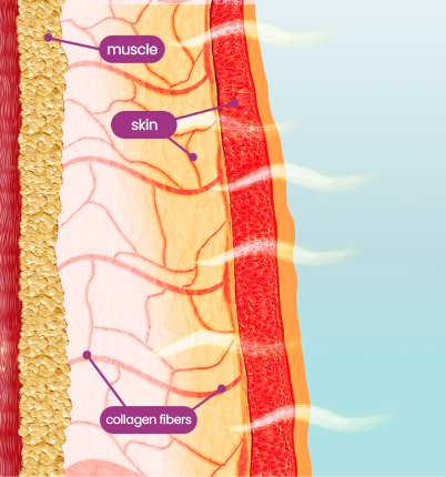 Thermage FLX, best English-speaking dermatology in Seoul