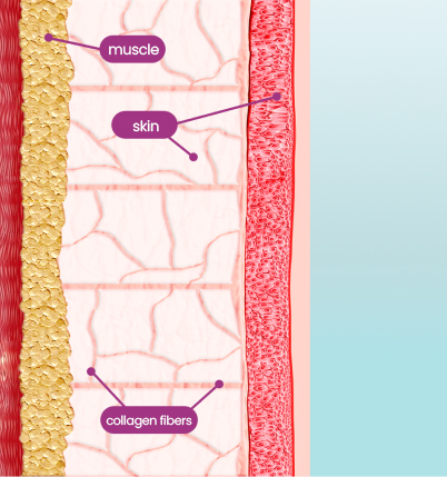 Thermage FLX, English speaking sagging skin treatment